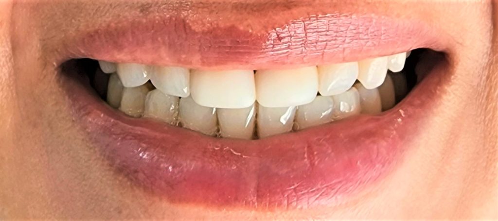 Teeth Whitening Moorabbin