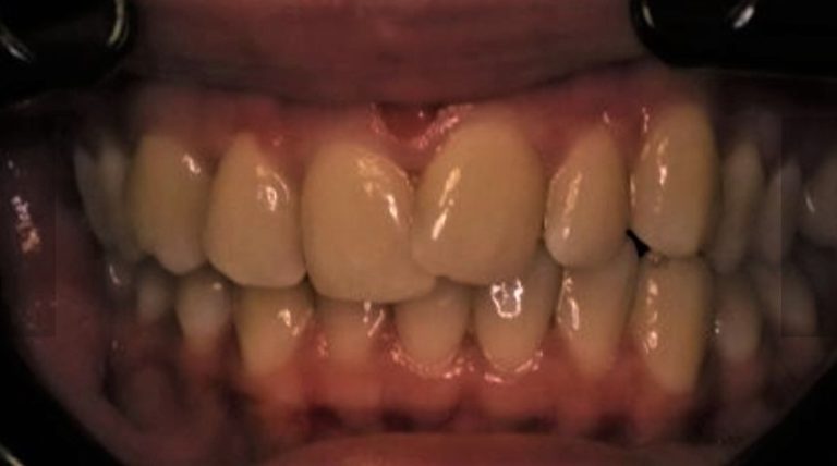 Teeth Whitening Murrumbeena