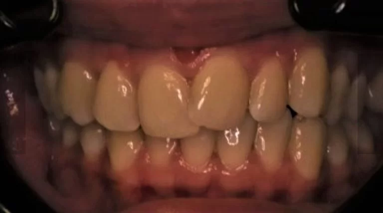 Teeth Whitening Murrumbeena