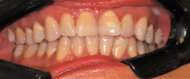 Teeth Whitening Clayton